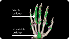 Dual Energy CT scan of hand showing visible and nonvisible buildup in gout patient