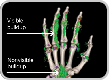 Dual Energy CT scan of hand showing visible and nonvisible buildup in gout patient