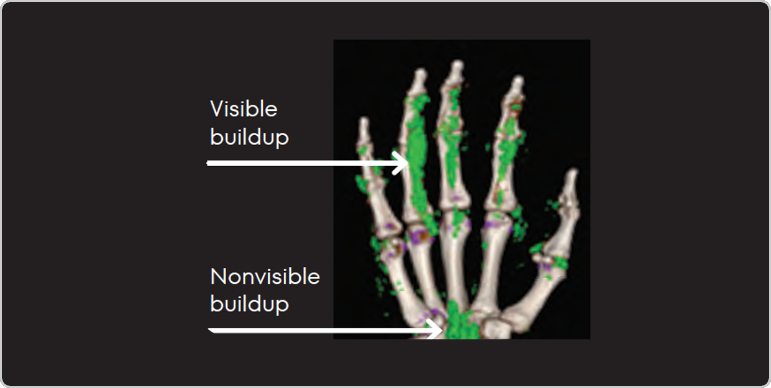 Dual Energy CT scan of hand showing visible and nonvisible buildup in gout patient