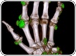 Dual Energy CT scan of hand in gout patient at baseline