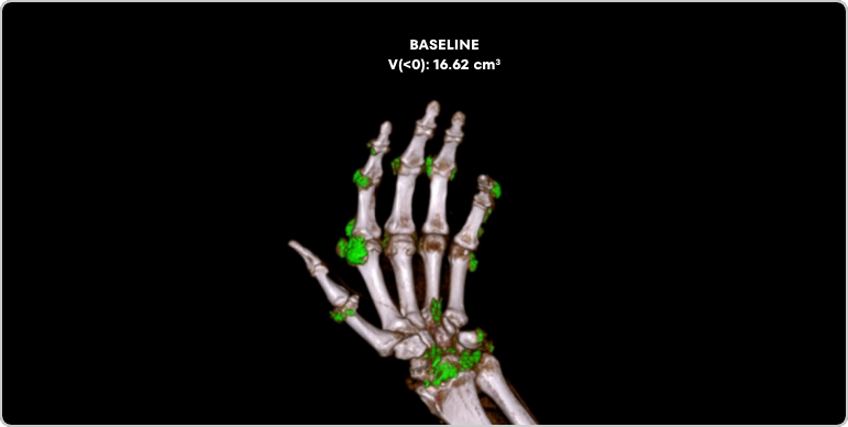 Dual Energy CT scan of hand in gout patient at baseline