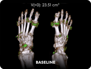 DECT image of uric acid deposits from gout in feet of KRYSTEXXA with methotrexate patient at baseline