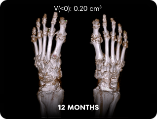 DECT image of uric acid deposits from gout in feet of KRYSTEXXA with methotrexate patient at 12 months