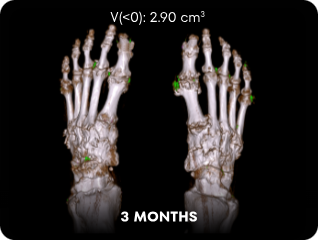 DECT image of uric acid deposits from gout in feet of KRYSTEXXA with methotrexate patient at 3 months