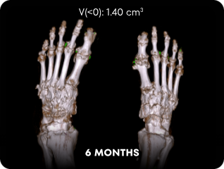 DECT image of uric acid deposits from gout in feet of KRYSTEXXA with methotrexate patient at 6 months