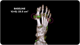 Dual Energy CT scan of uric acid buildup in foot at baseline