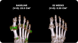 Side by side Dual Energy CT scans showing uric acid buildup in foot before and after KRYSTEXXA with methotrexate treatment