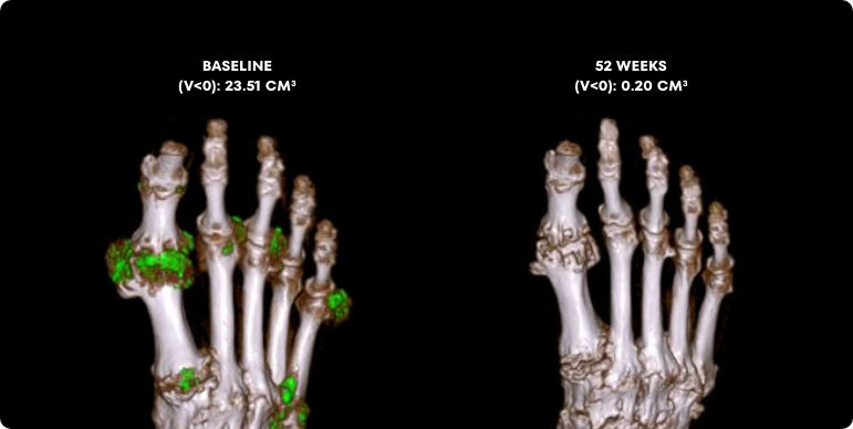 Side by side Dual Energy CT scans showing uric acid buildup in foot before and after KRYSTEXXA with methotrexate treatment