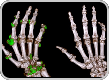 Side by side Dual Energy CT scans showing uric acid buildups in a gout patient at baseline and at Week 52 of treatment