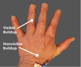 Visible buildup from gout in hand picture