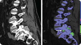 DECT scans of lumbar spine showing tophaceous deposits