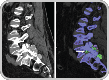 DECT scans of lumbar spine showing tophaceous deposits