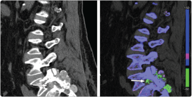 DECT scans of lumbar spine showing tophaceous deposits