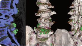 DECT scans of lower spine showing tophaceous deposits