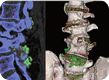 DECT scans of lower spine showing tophaceous deposits