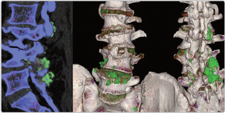 DECT scans of lower spine showing tophaceous deposits