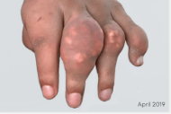 Image of visible tophi in hand before KRYSTEXXA treatment