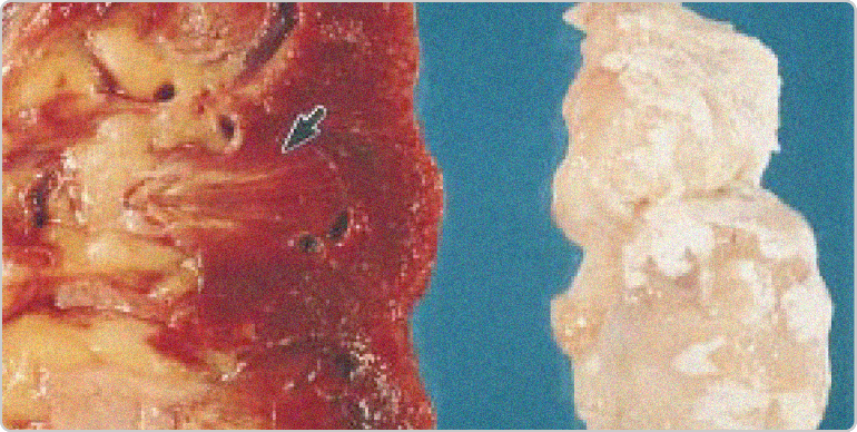 Images of gouty tophi in joint and kidney