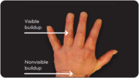 Image of tophi in hands with both visible and nonvisible buildup