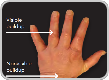 Image of tophi in hands with both visible and nonvisible buildup