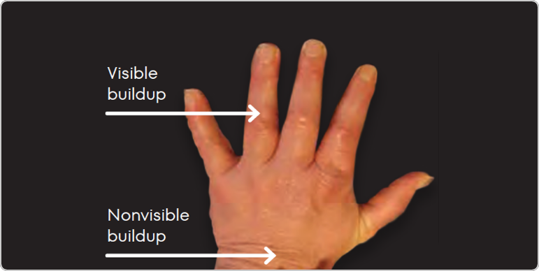 Image of tophi in hands with both visible and nonvisible buildup