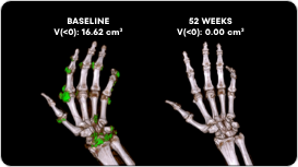 Side by side Dual Energy CT scans showing uric acid buildups in a gout patient at baseline and at Week 52 of treatment