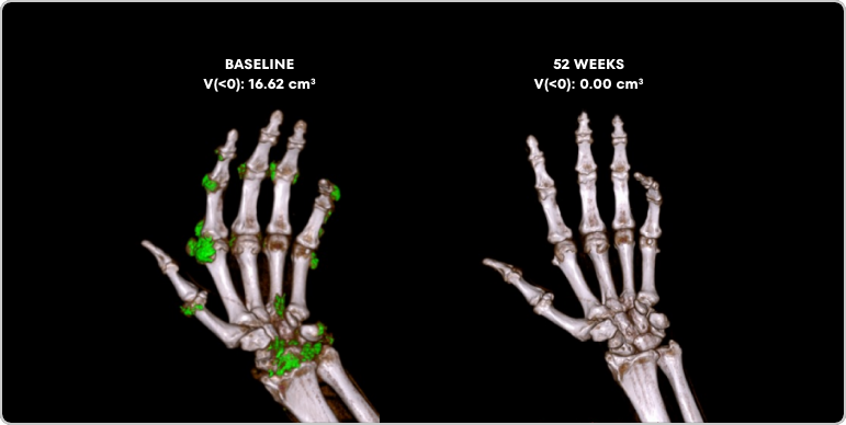 Side by side Dual Energy CT scans showing uric acid buildups in a gout patient at baseline and at Week 52 of treatment