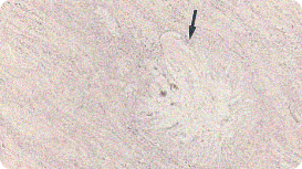 Image of gouty tophus in the renal medulla