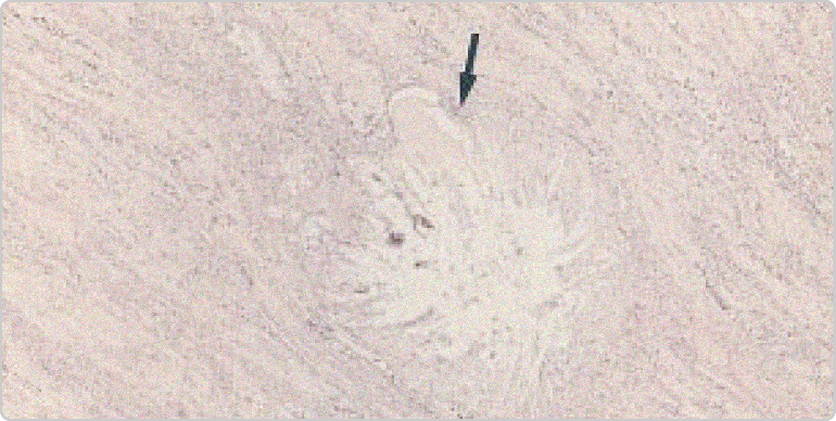 Image of gouty tophus in the renal medulla