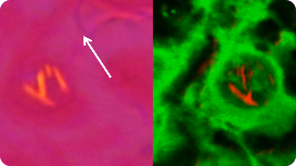 Image of negatively birefringent crystals in gout microscopy