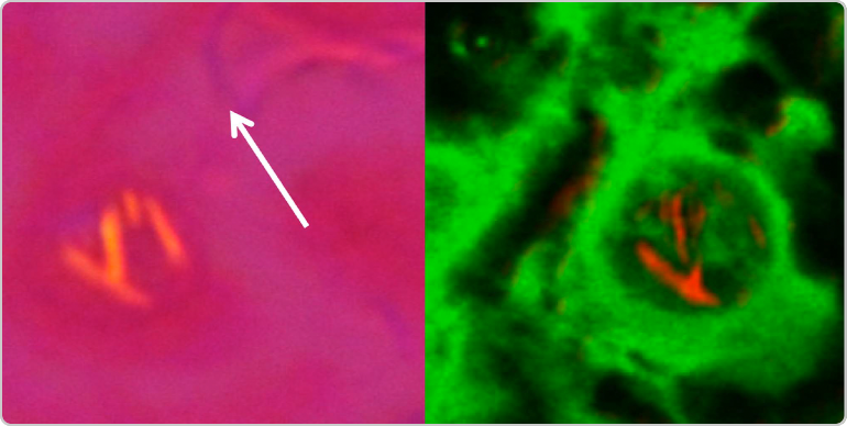 Image of negatively birefringent crystals in gout microscopy