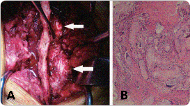 Photo of tophi from gout in spine