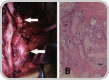 Photo of tophi from gout in spine