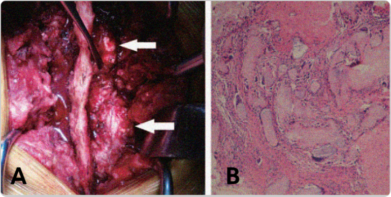 Photo of tophi from gout in spine