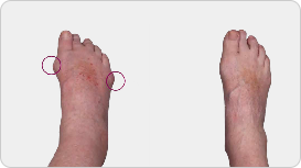 Side by side pictures of tophi on foot before and after KRYSTEXXA with methotrexate treatment