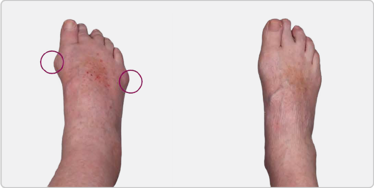 Side by side pictures of tophi on foot before and after KRYSTEXXA with methotrexate treatment