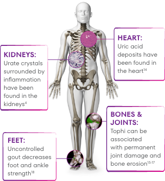 Graphic showing how that uric acid deposits have been found in the heart, chronic kidney disease is linked to elevated sUA levels, tophi can be associated with joint damage and bone erosion, and uncontrolled gout decreases foot and ankle strength