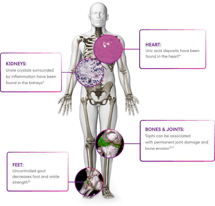 Graphic showing how that uric acid deposits have been found in the heart, chronic kidney disease is linked to elevated sUA levels, tophi can be associated with joint damage and bone erosion, and uncontrolled gout decreases foot and ankle strength