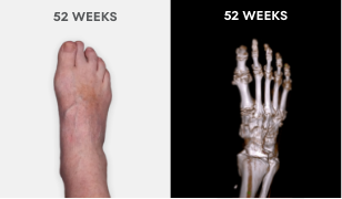  Photo showing no visible tophi in foot as well as no uric acid deposits in DECT scan after 52 weeks of treatment