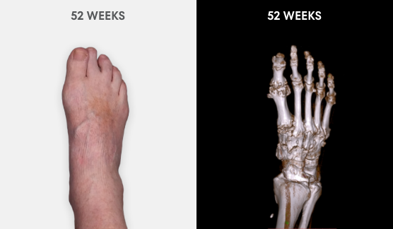  Photo showing no visible tophi in foot as well as no uric acid deposits in DECT scan after 52 weeks of treatment