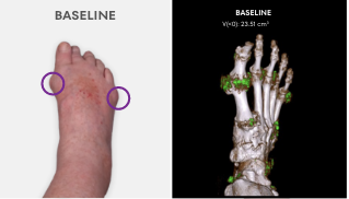 Baseline photo showing visible tophi in foot as well as uric acid deposits in DECT scan