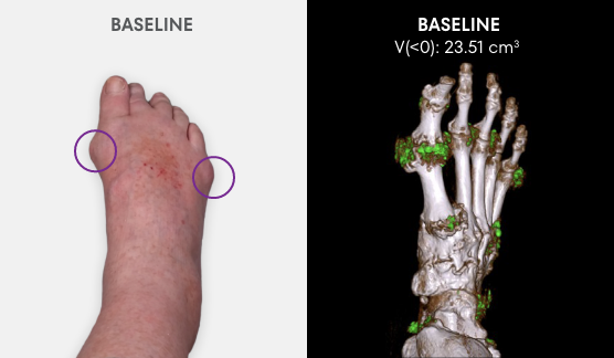 Baseline photo showing visible tophi in foot as well as uric acid deposits in DECT scan