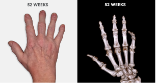  Photo showing no visible tophi in hand as well as no uric acid deposits in DECT scan after 52 weeks of treatment