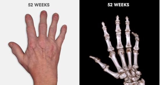  Photo showing no visible tophi in hand as well as no uric acid deposits in DECT scan after 52 weeks of treatment