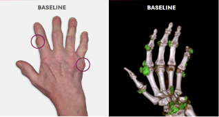 Baseline photo showing visible tophi in hand as well as uric acid deposits in DECT scan