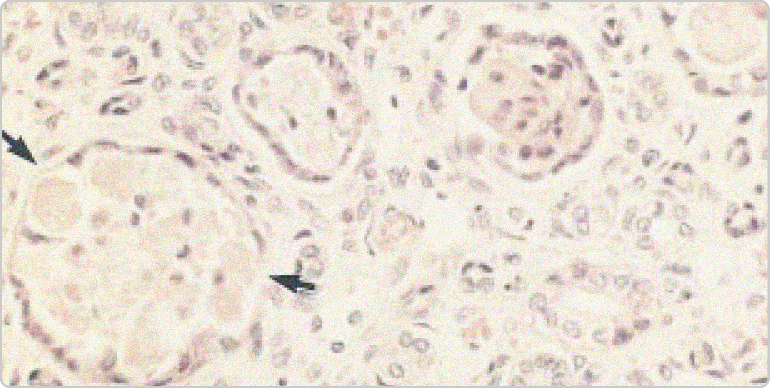 Image of urate in ducts of renal medulla