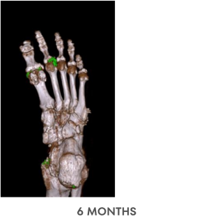 A series of Dual Energy Computed Tomography (DECT) scans before and after KRYSTEXXA with methotrexate treatment, from baseline to 6 months to 12 months, showing reduced uric acid deposits in a foot