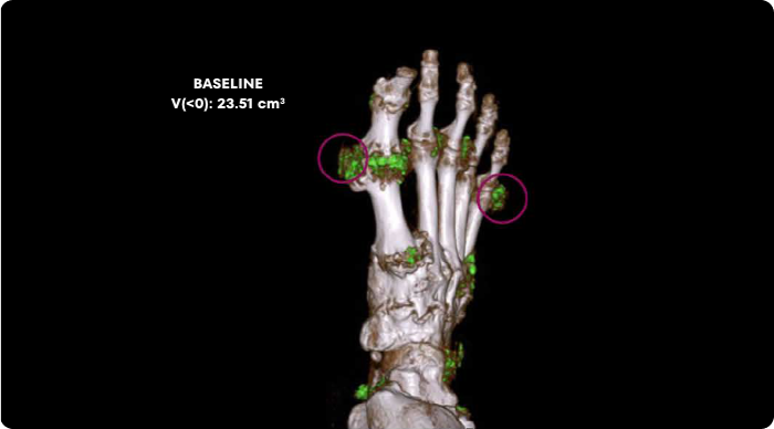 Dual Energy CT scan of uric acid buildup in foot at baseline