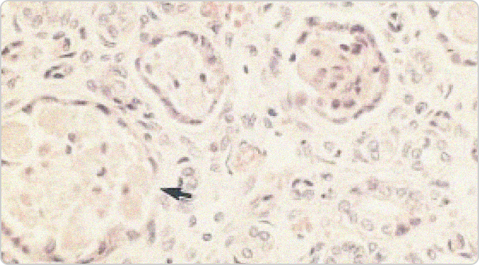 Image of urate in ducts of renal medulla