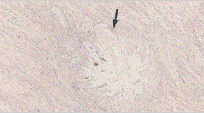 Image of gouty tophus in the renal medulla